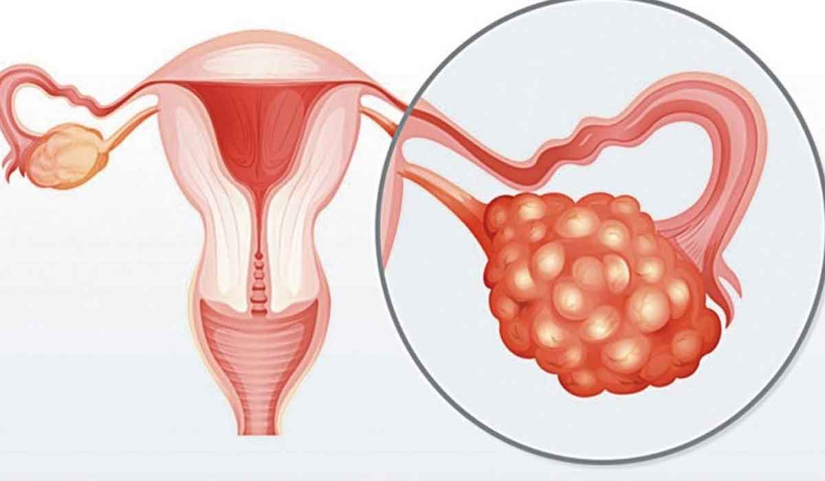 Ce este sindromul ovarelor polichistice. Semnele ce nu trebuie ignorate