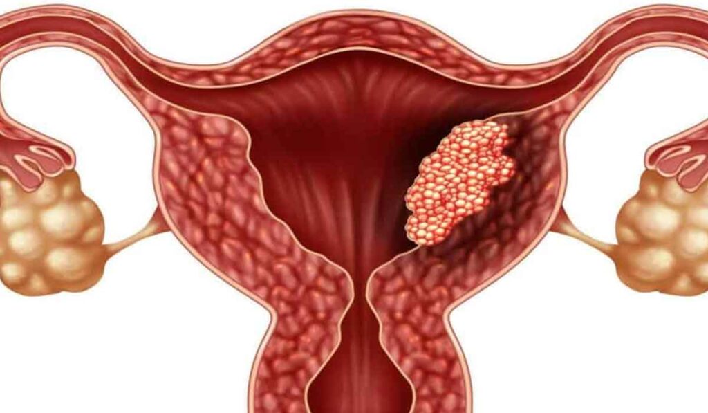 Semne ale cancerului de prostata