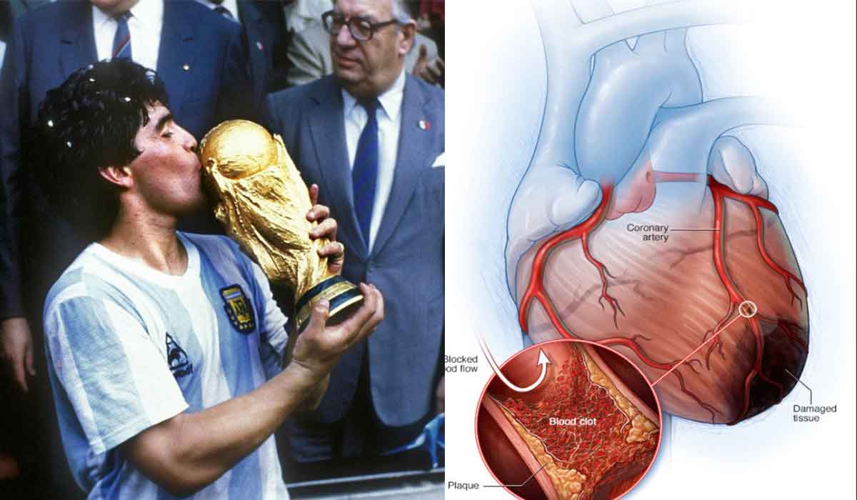 Ce este atacul de cord, boala care l-a rapus pe Diego Maradona. Care sunt simptomele ce nu trebuie ignorate
