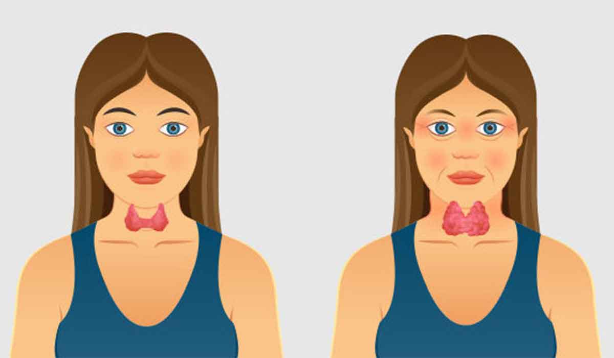 Care sunt simptomele in Hipertiroidism si Hipotiroidism