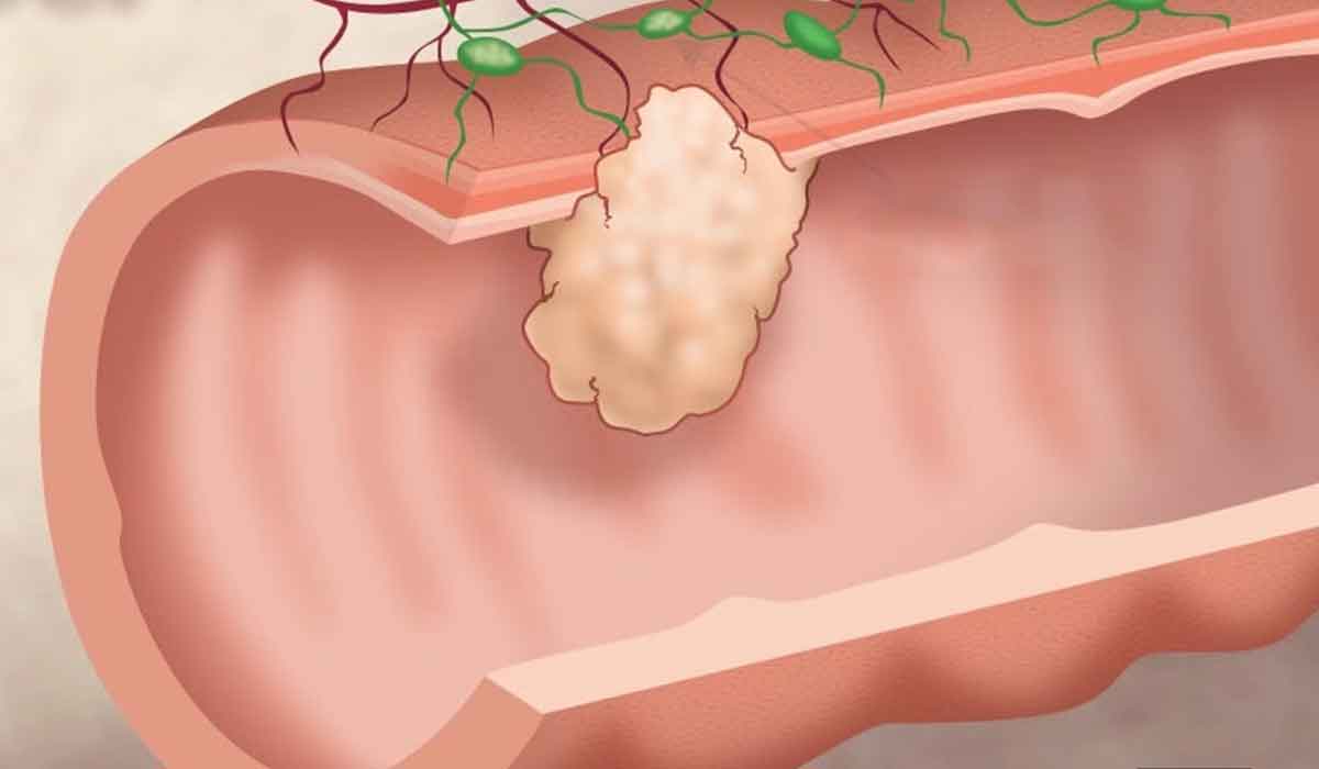 Primele simptome ale cancerului de colon
