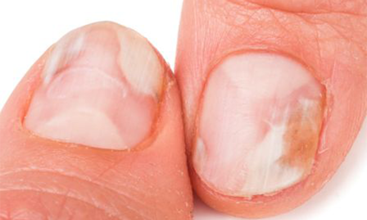 Ce ajuta cu adevarat la infectiile fungice ale unghiilor
