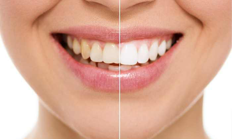 3 modalitati simple de a va albi in mod natural dintii acasa