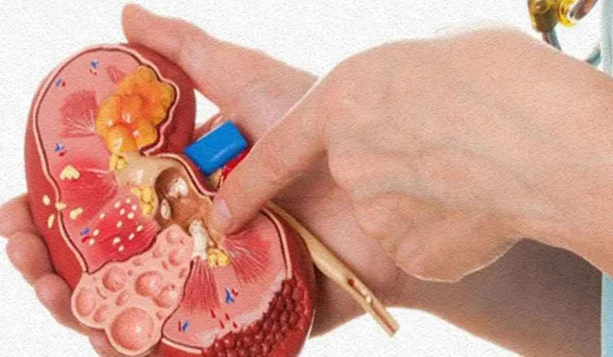 Măsuri eficiente care «dizolvă» pietrele la rinichi