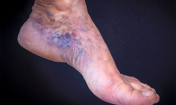 tromboza picior simptome