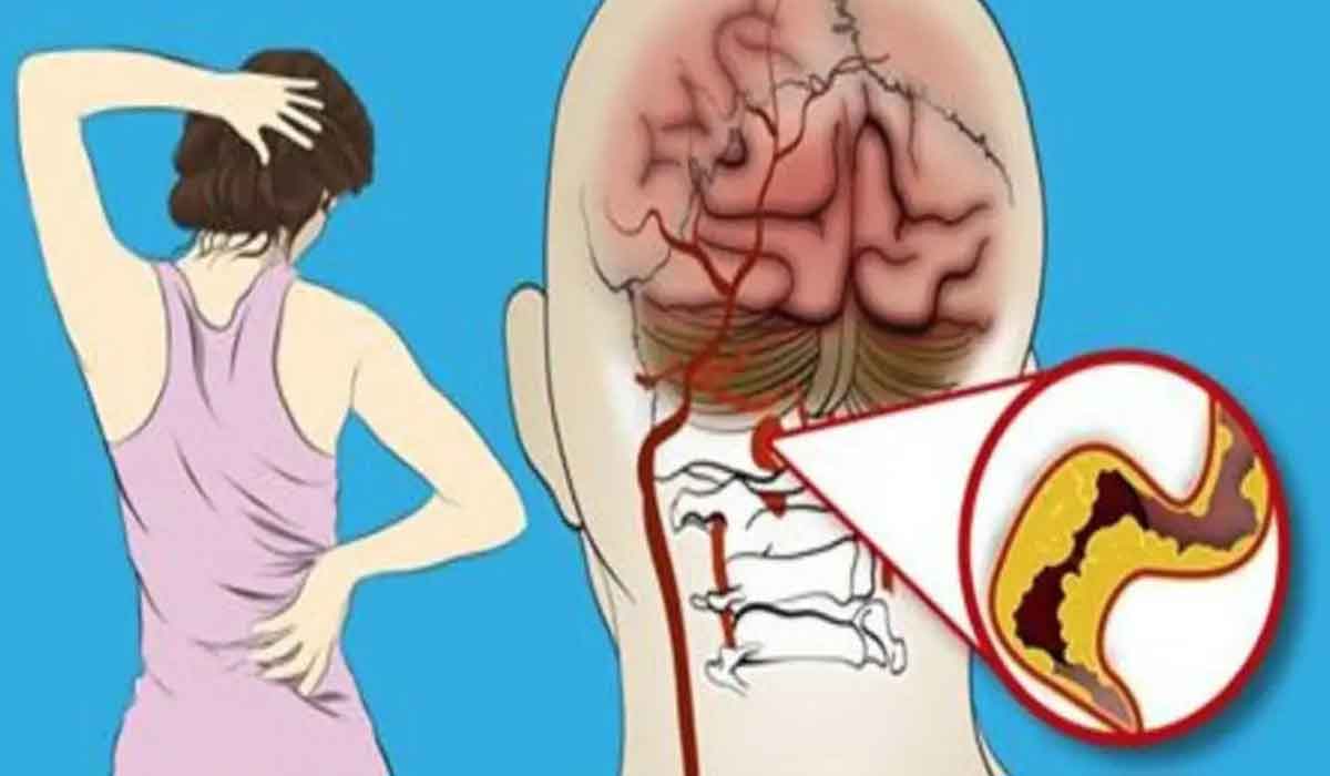 9 semne ale accidentului vascular cerebral(AVC) la femei pe care ar trebui sa le cunoasteti