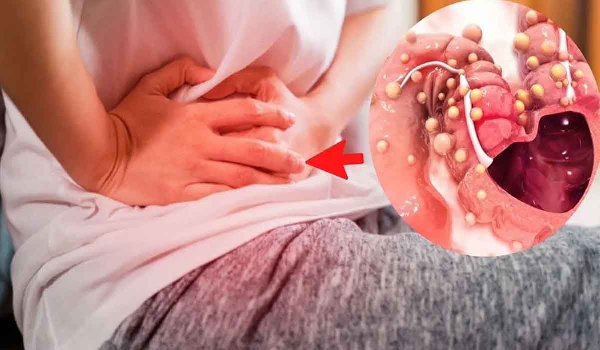 Cancerul de colon: 9 simptome care identifica acest „dusman” nu atat de tacut
