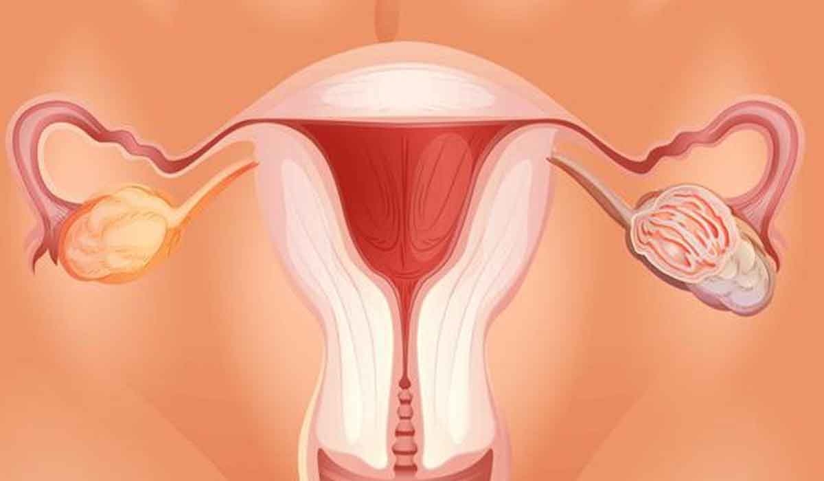 10 simptome ale cancerului ovarian la care femeile ar trebui sa fie atente