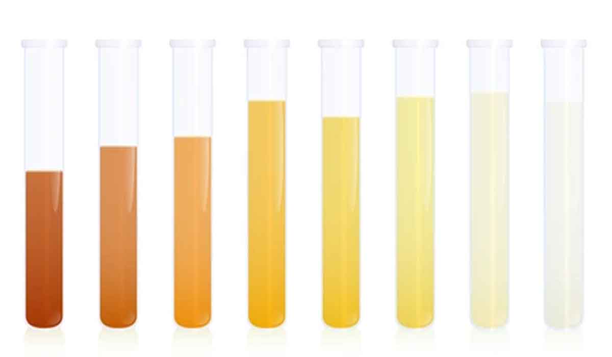 Culorile urinei si semnificatiile lor