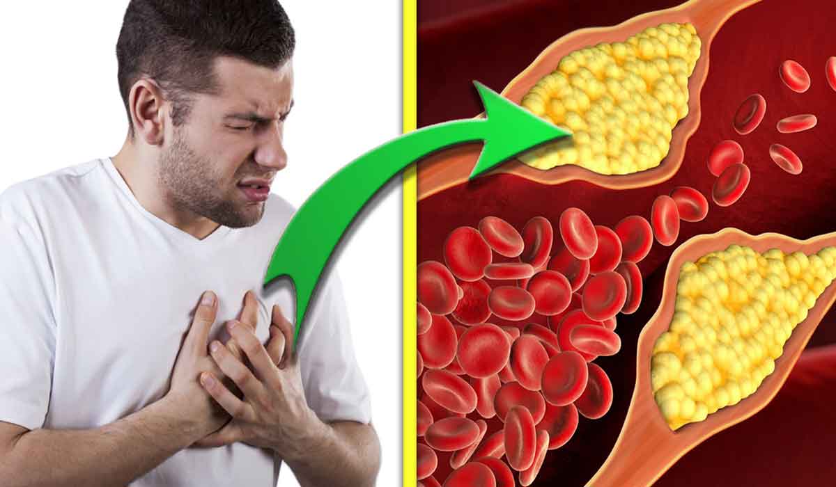 Ce alimente pot creste nivelul de colesterol rau din sange