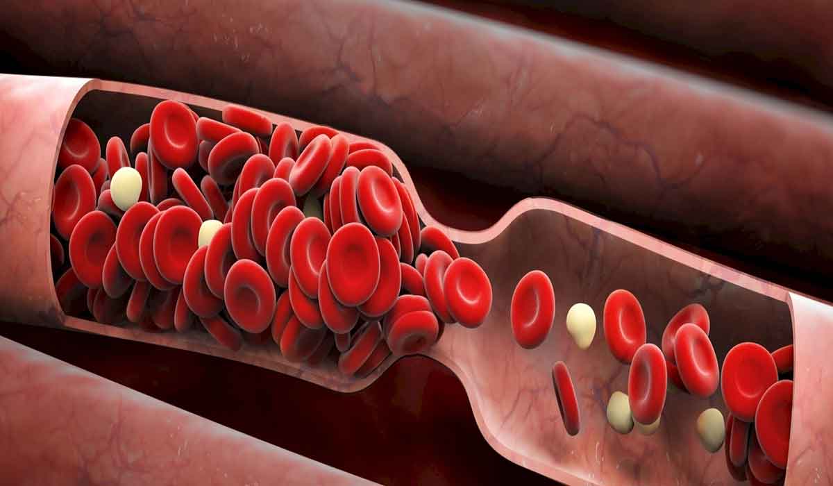 Alimente care subtiaza sangele si protejeaza impotriva cheagurilor de sange